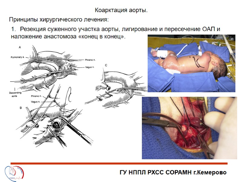 ГУ НППЛ РХСС СОРАМН г.Кемерово Коарктация аорты. Принципы хирургического лечения: Резекция суженного участка аорты,